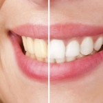 Tips para blanquear los dientes de forma natural