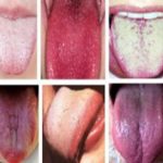 Cambios en la lengua: revelarán tus enfermedades