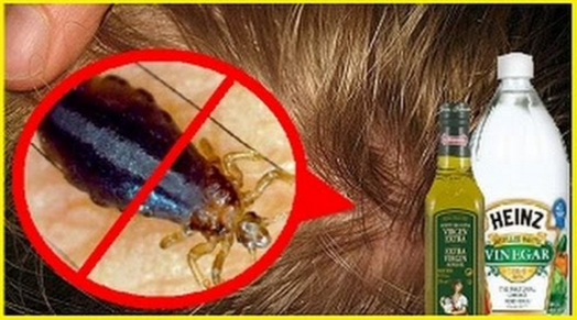 Elimina los piojos y liendres de tu cabeza con ayuda de estos remedios caseros