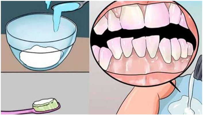 Blanquea tus dientes, elimina el sarro y la placa bacterial en unos minutos con esto