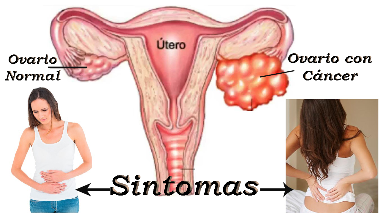 7 Síntomas del cáncer de ovario que toda mujer tiene que conocer para que pueda detenerlo a tiempo